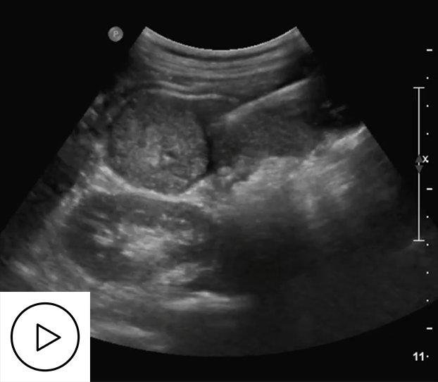 3DLIVUS tracking: Needle tracking